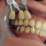 ジルコニアブリッジ