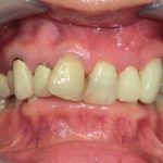 オールセラミックで綺麗な前歯に
