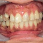 無痛と審美治療