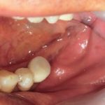 入れ歯からインプラント