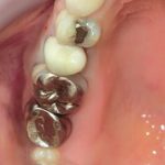 ジルコニアＣｒ