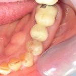 ジルコニアモノコックＣｒ