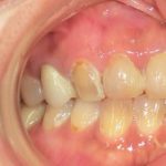 ジルコニアクラウン