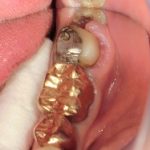 金歯からセラミックへ