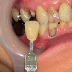 ジルコニアモノコックＣｒ