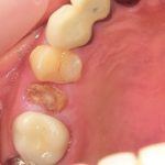 歯が折れてからの修復