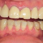 無痛治療で神経の処置