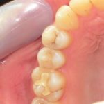 ジルコニアクラウン