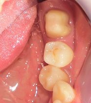 ジルコニアモノコックＣｒ