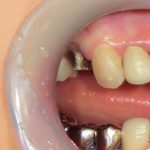 銀歯から白い歯へ