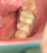 ジルコニアインレー