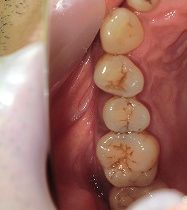 ジルコニアインレー