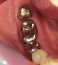 銀歯からセラミックへ