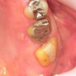 ジルコニアＣｒ