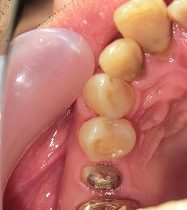 ジルコニアモノコックＣｒ