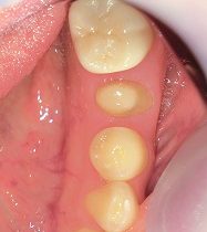 強度のあるジルコニアモノコックＣｒ