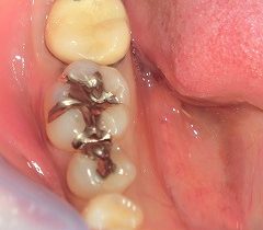 虫歯の無痛治療