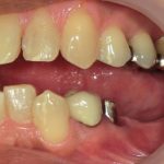 ジルコニアクラウン