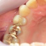 ジルコニアインレー