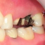 ジルコニアパールクラウンで修復