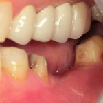 ジルコニアＢｒ