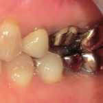 銀歯からジルコニアＣｒへ