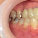 オールセラミックＢｒ