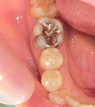 ジルコニアクラウン