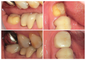 ジルコニアクラウン