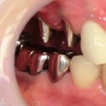 ジルコニアクラウンで連結