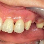 歯周病とジルコニアブリッジ