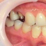 ジルコニアクラウン