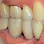 インプラント治療