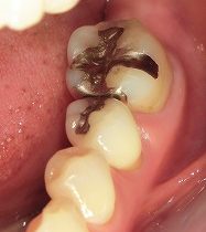 ジルコニアでの治療