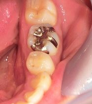 銀の詰め物が欠けた