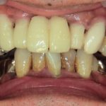 原因は歯周病・・・