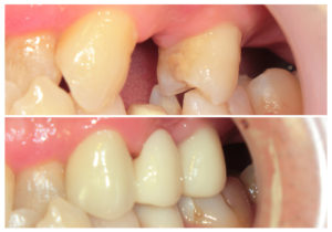 レアリングタイプのブリッジ