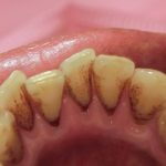 たばこのヤニ取り