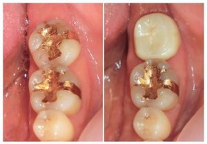 ジルコニアクラウン