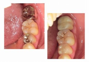 ジルコニアクラウンとジルコニアインレー