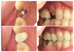 ジルコニアクラウン