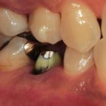 ゼノスター使用のジルコニアクラウン