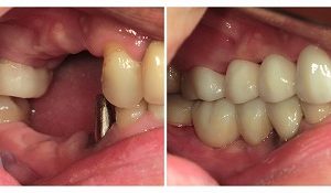 ジルコニアクラウンブリッジ