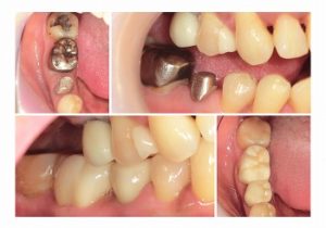 ジルコニアクラウン