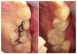 ジルコニアインレー