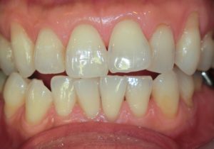 ホワイトニング