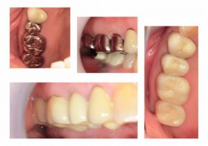 ジルコニアモノコッククラウン