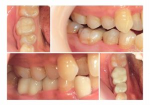 ジルコニアクラウン