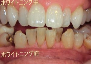 オフィスホワイトニング