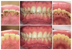 パウダーを使ってのホワイトニング